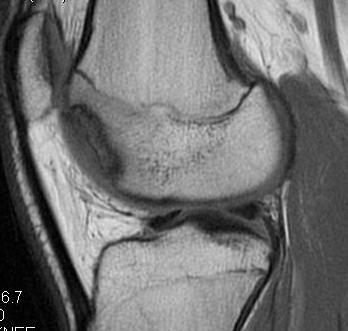 Trochlea OCD Post Patella DIslocation Sagittal